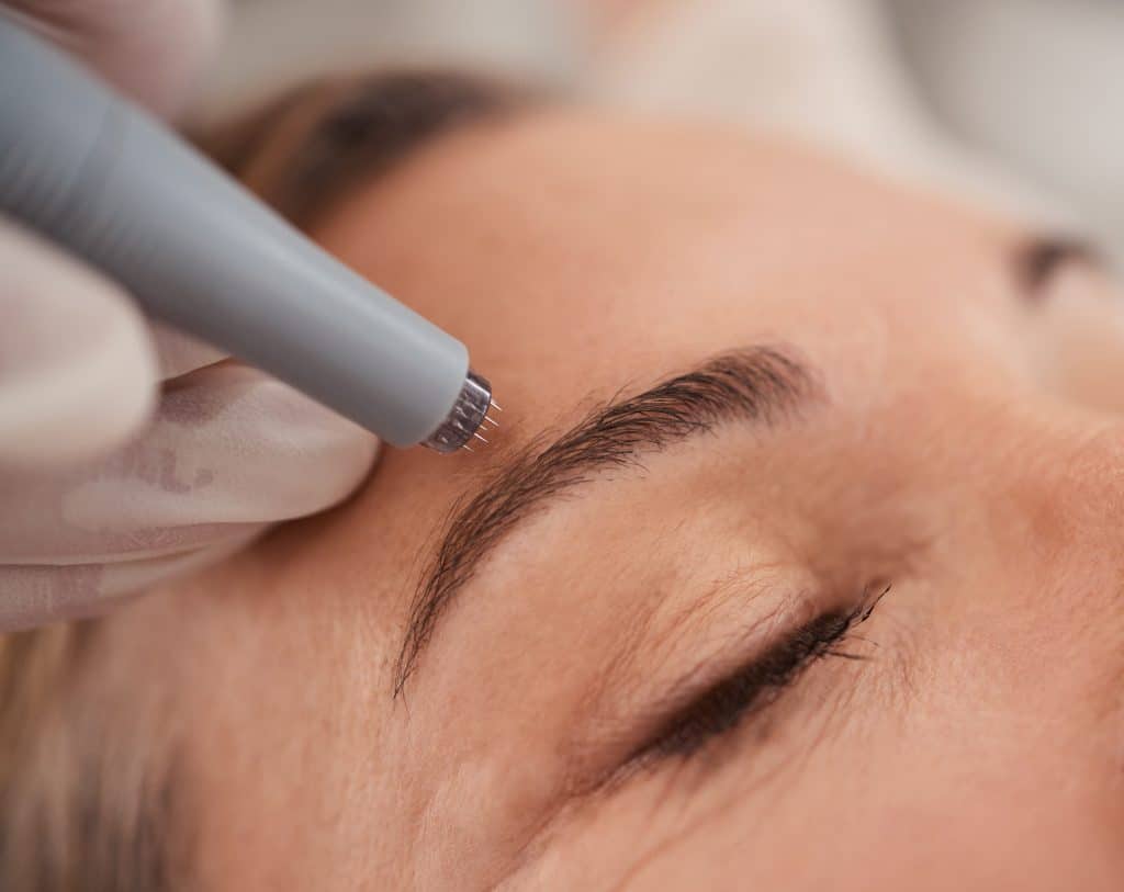 Kvinde får microneedling behandling
