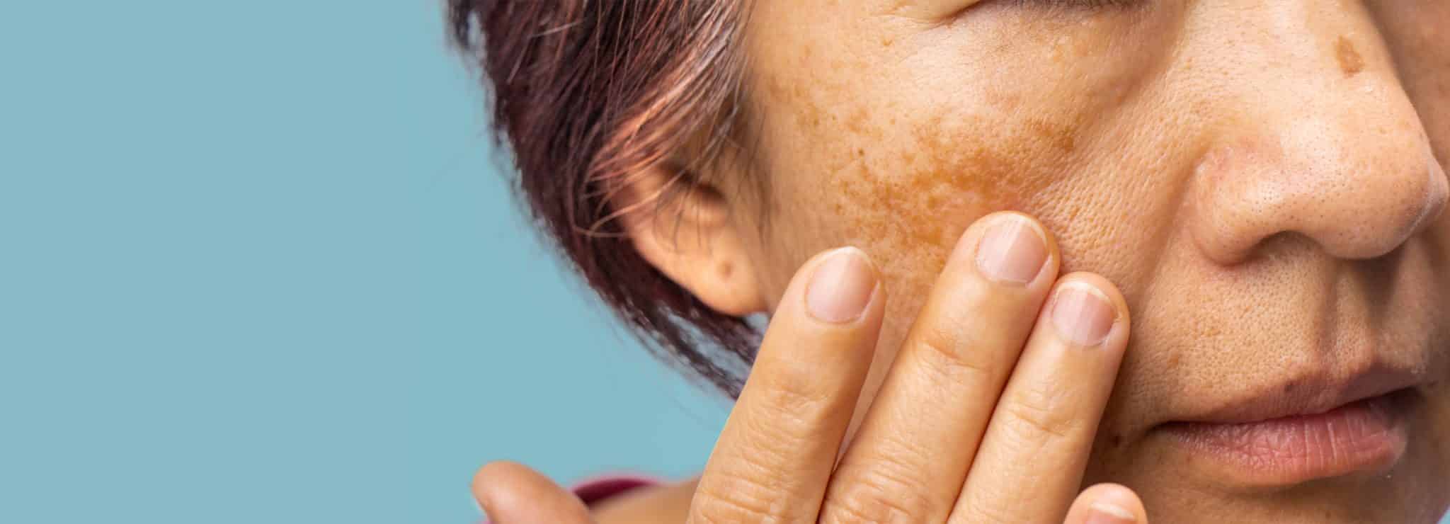 Kvinde med Melasma - pigmenterpletter i ansigtet