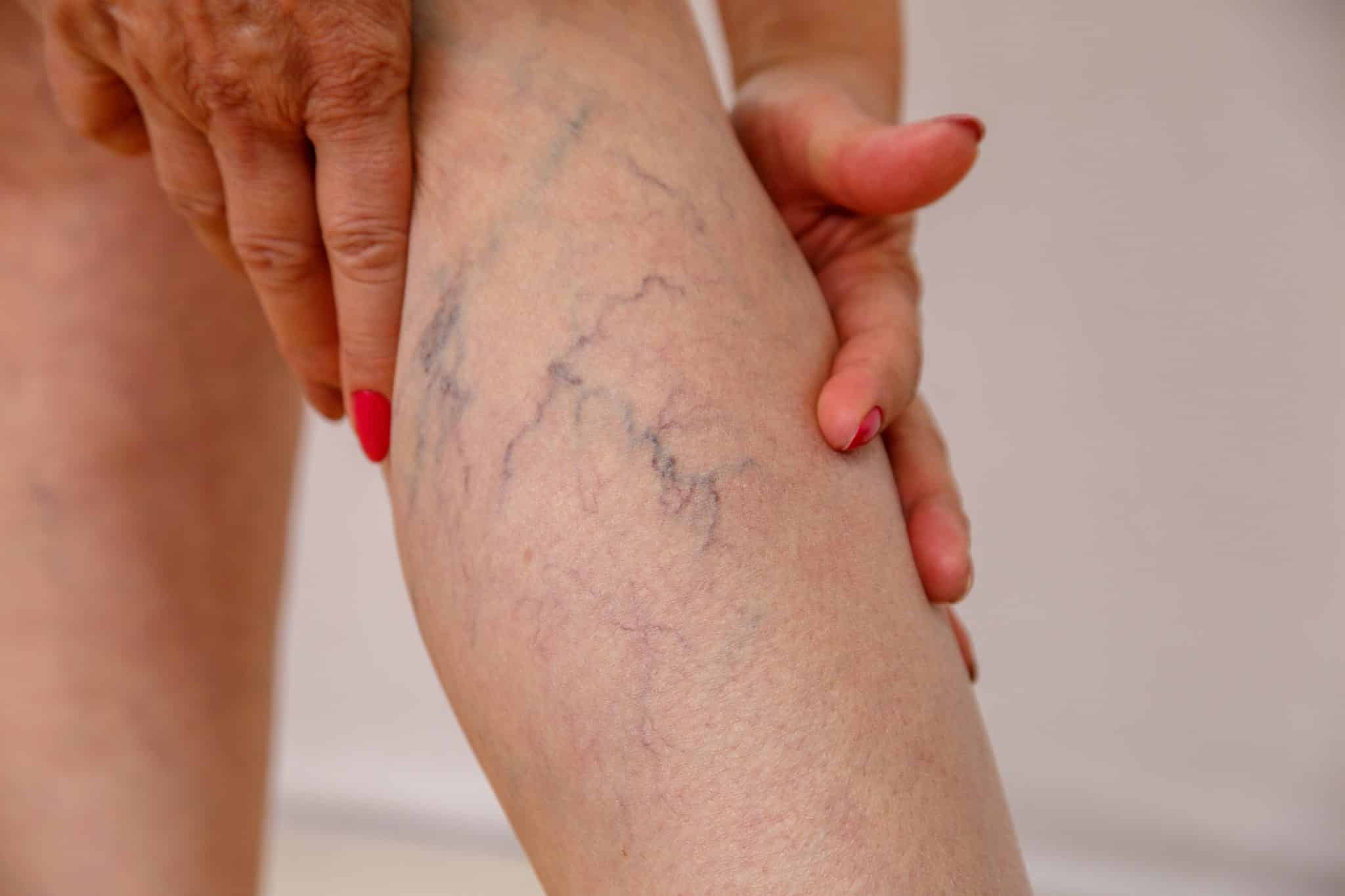 kvindes ben med karsprængninger og åreknuder