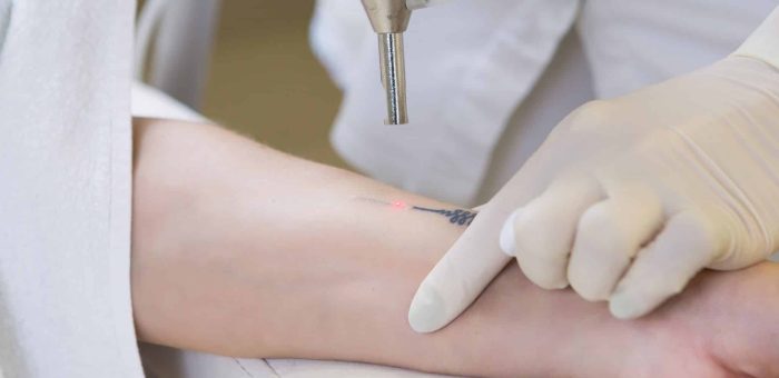 Cosmetologist doing laser tattoo removal from woman hand in cosmetology clinic