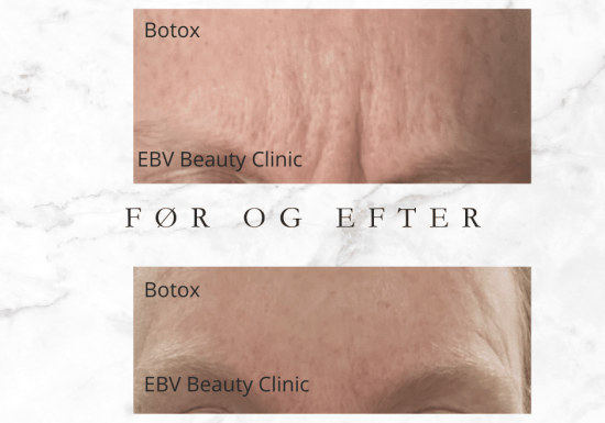 Botox - før og efter
