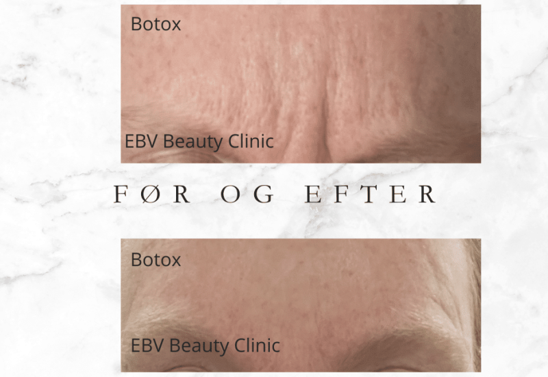 Botox - før og efter